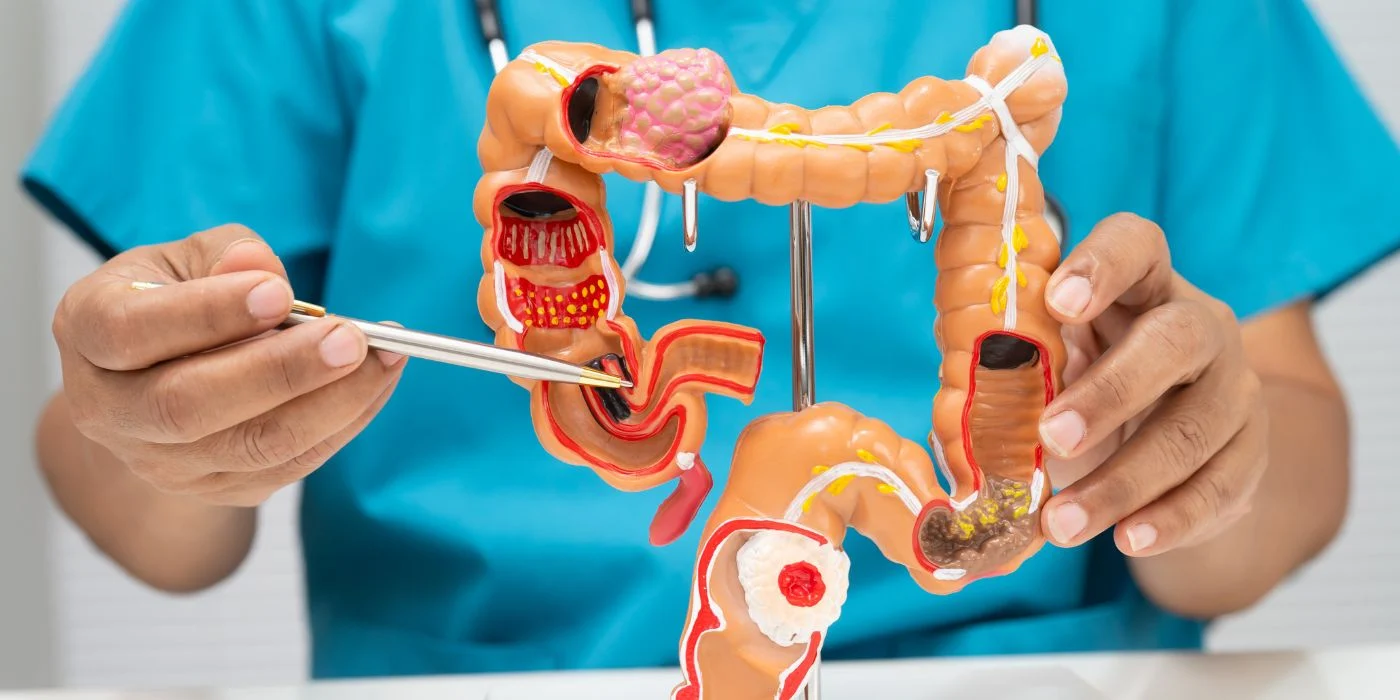 Cáncer colorrectal, tercera neoplasia más frecuente en Colombia, impulsa el debate sobre el valor económico de nuevas terapias en el sistema de salud